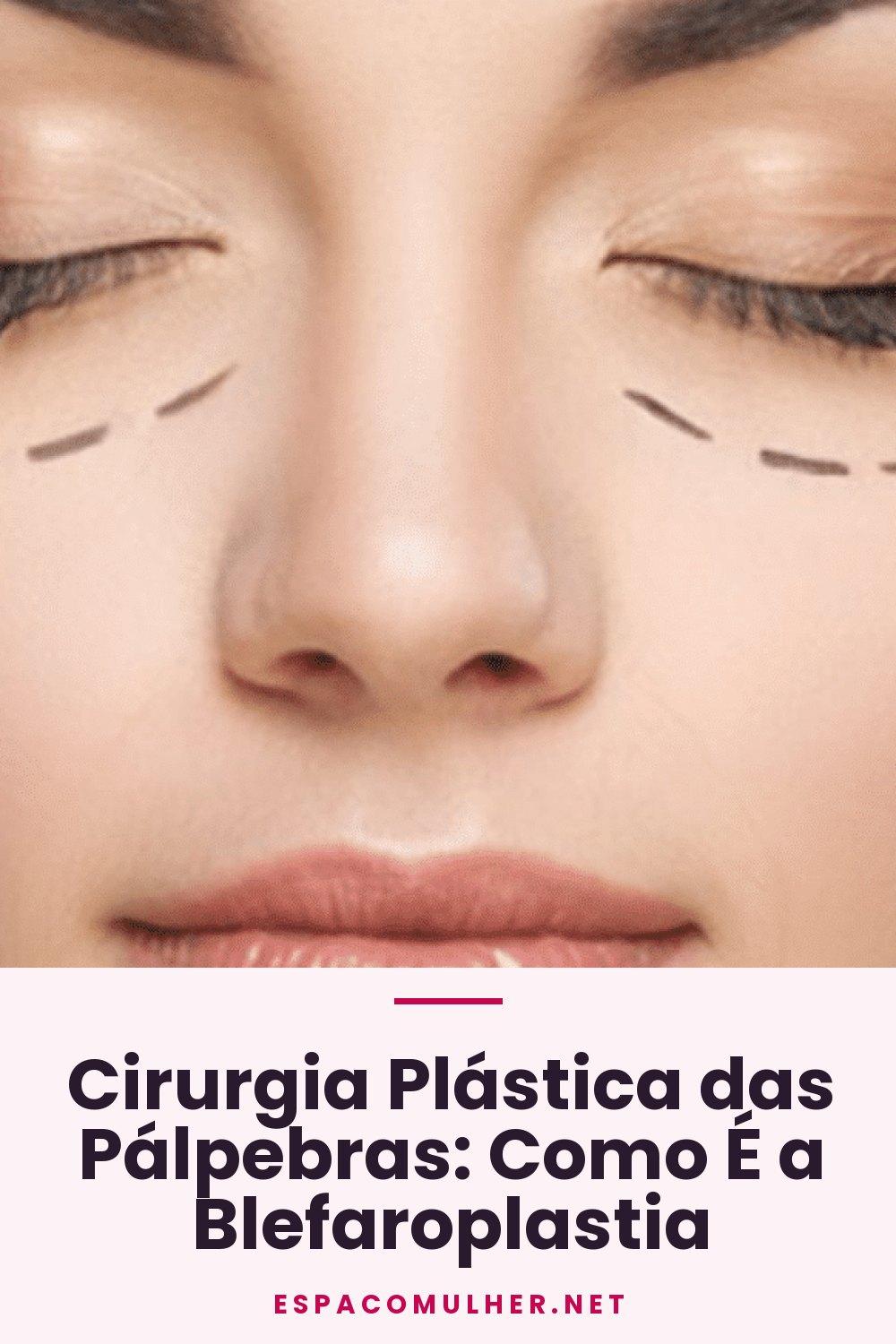 Cirurgia Plástica das Pálpebras: Como É a Blefaroplastia