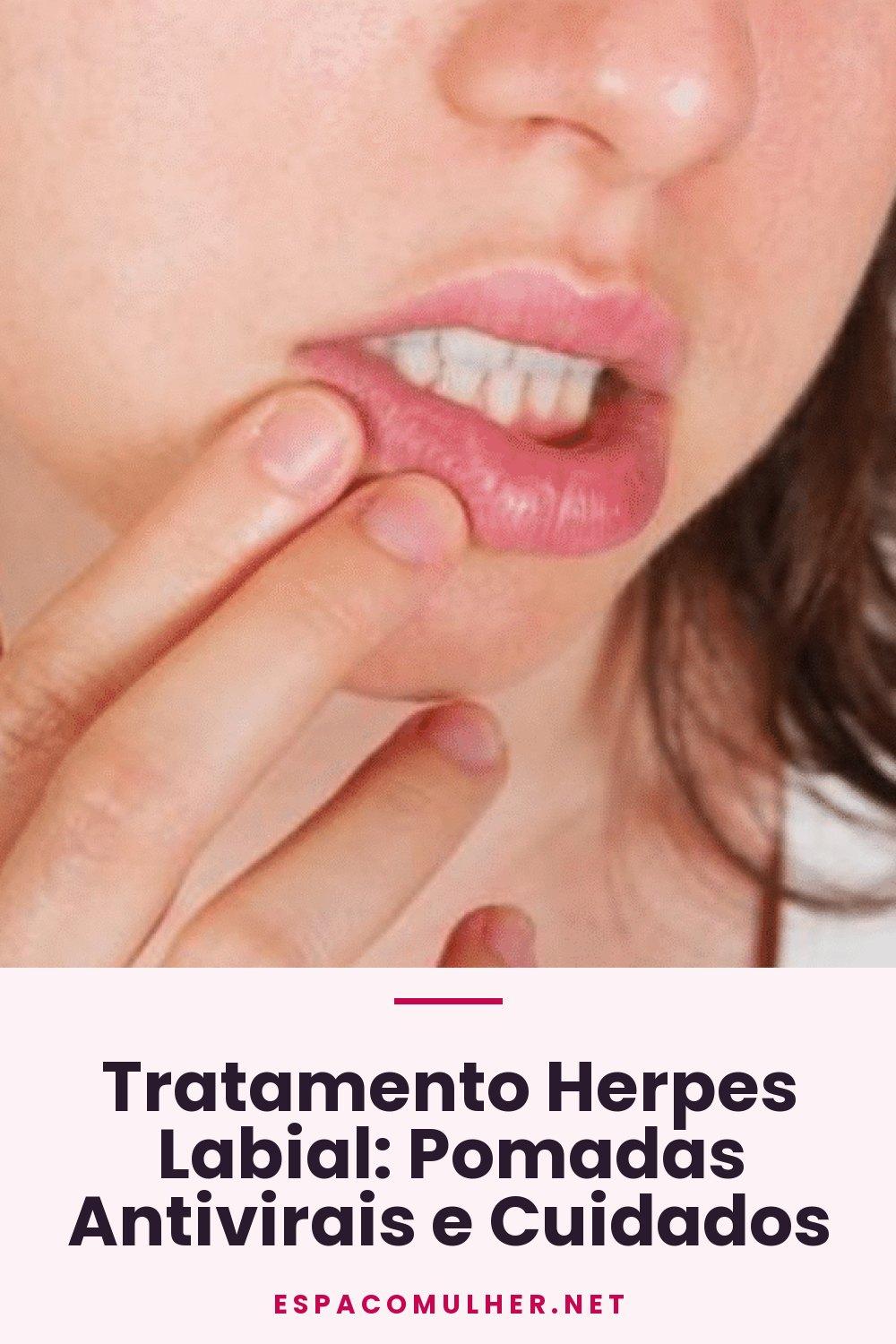 Tratamento Herpes Labial: Pomadas Antivirais e Cuidados
